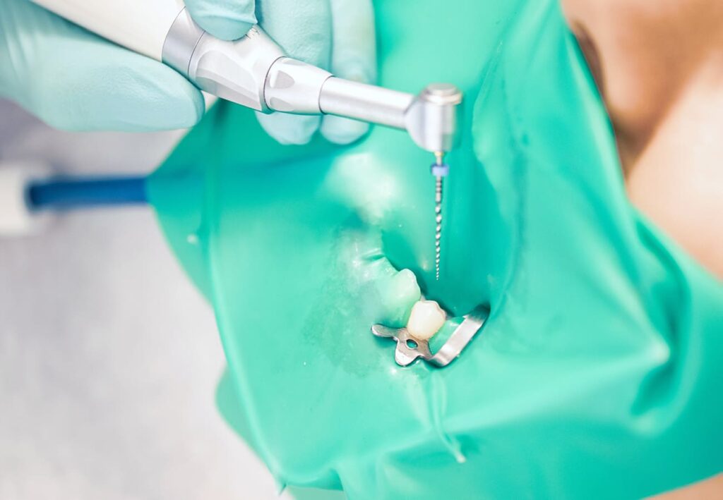 根管治療・温存療法